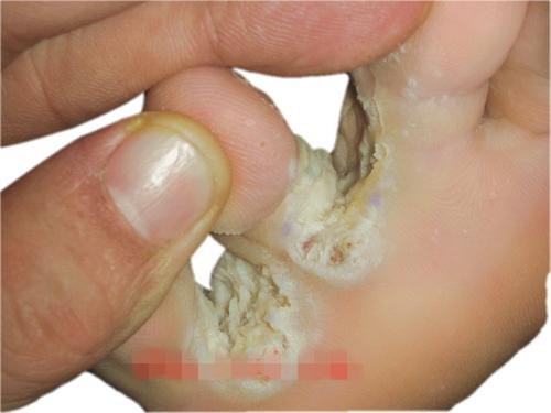 角化型手足癣的症状图片