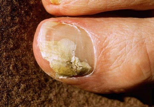 灰指甲判断方法请拿走!