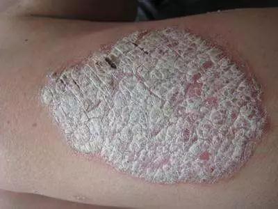 专业知识:手足皮肤病的自觉症状及他觉症状详解 非专业人士慎点!